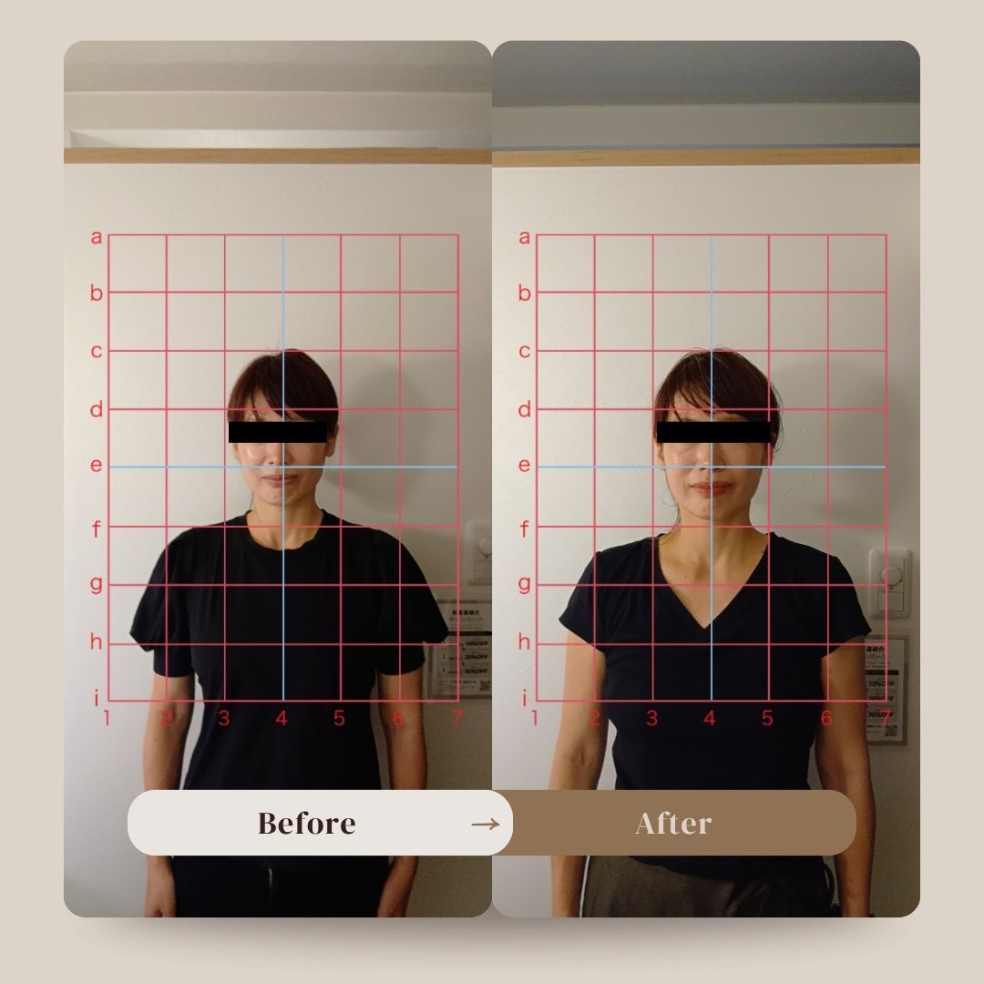 40代女性のBefore/After（施術後は左右のバランスが整い姿勢が改善）